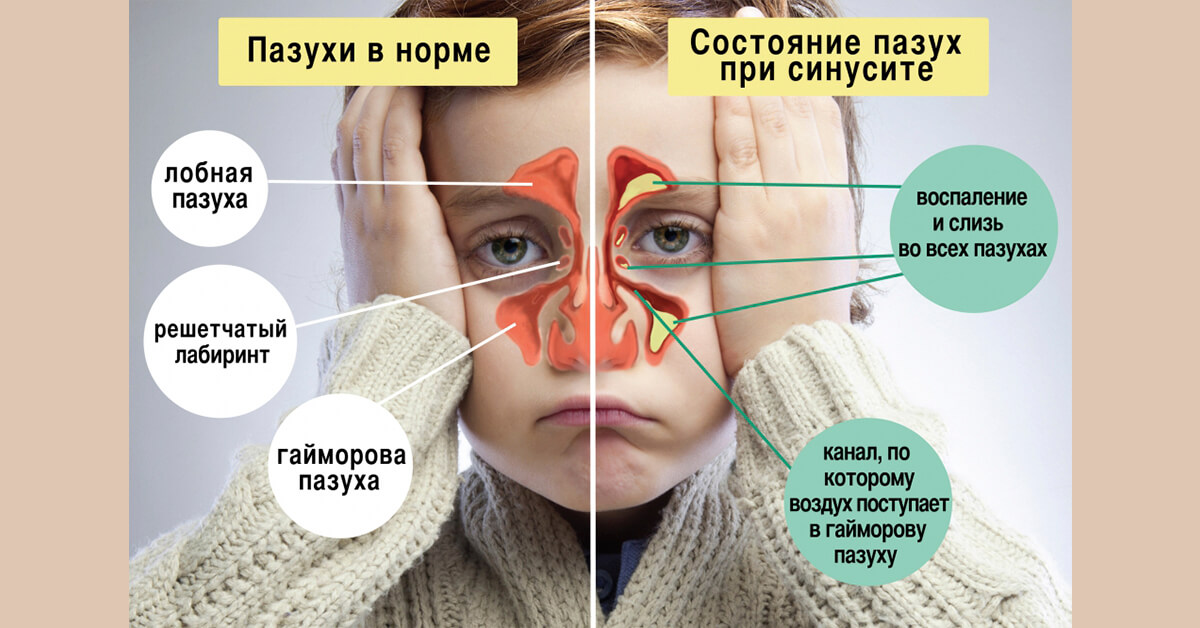 схема гайморита