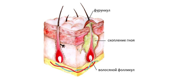 фурункул
