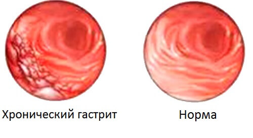 здоровый желудок и желудок с гастритом