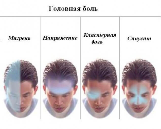 виды мигрени