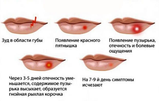 схема расположения герпеса на губах