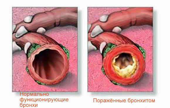 бронхи при бронхите