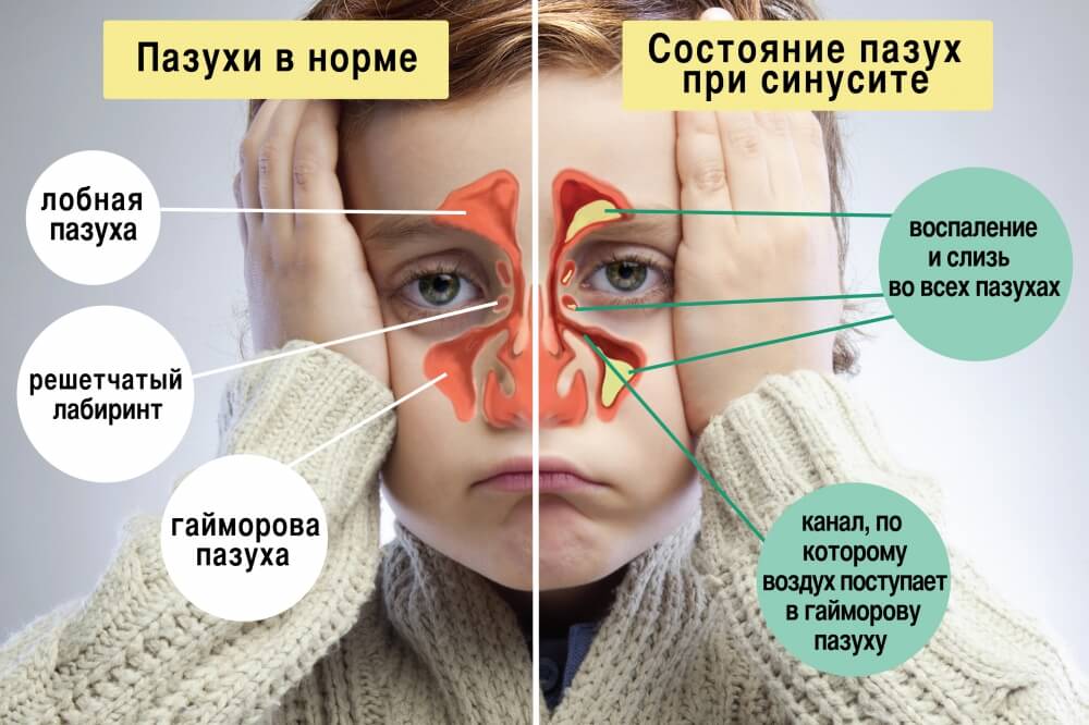 Схема синусита