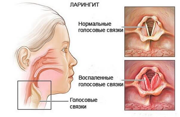 схема ларингита