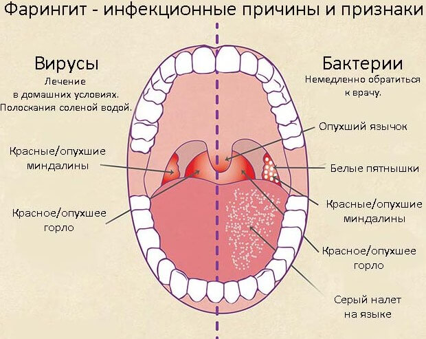 симптомы фарингита