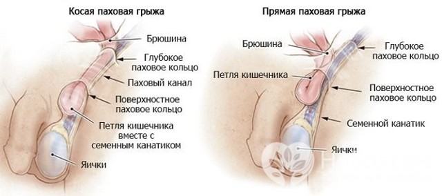 Паховая грыжа: симптомы, причины и варианты лечения