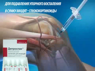 Как эффективно лечить бурсит коленного сустава и что это такое?