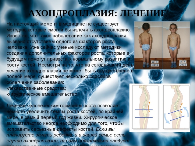 Ахондроплазия у детей: генетика и симптомы заболевания