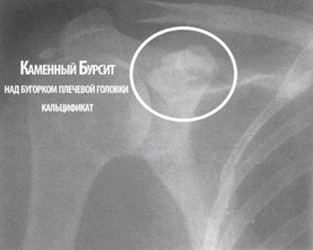 Как выглядит бурсит плечевого сустава, его первые симптомы и варианты лечения