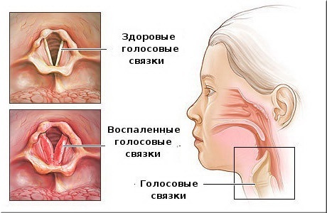 Первые симптомы ларинготрахеита, схема лечения и правила профилактики