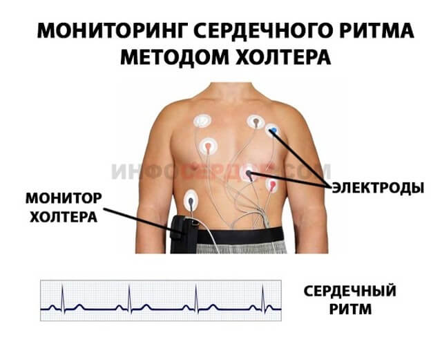 Желудочковая экстрасистолия, что это такое? Лечение и последствия