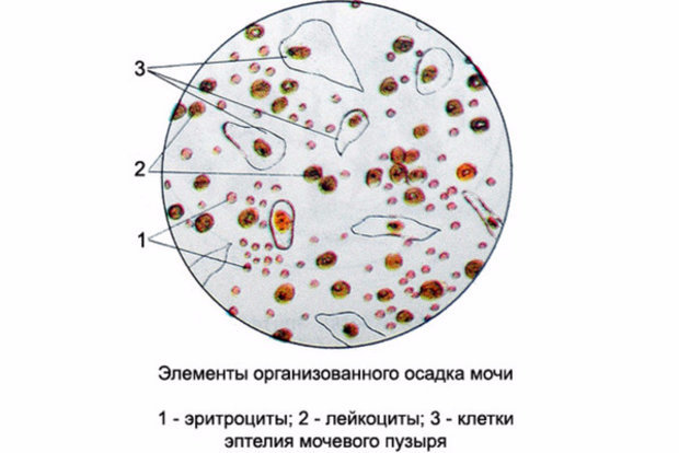 Лейкоциты в моче у женщин: норма