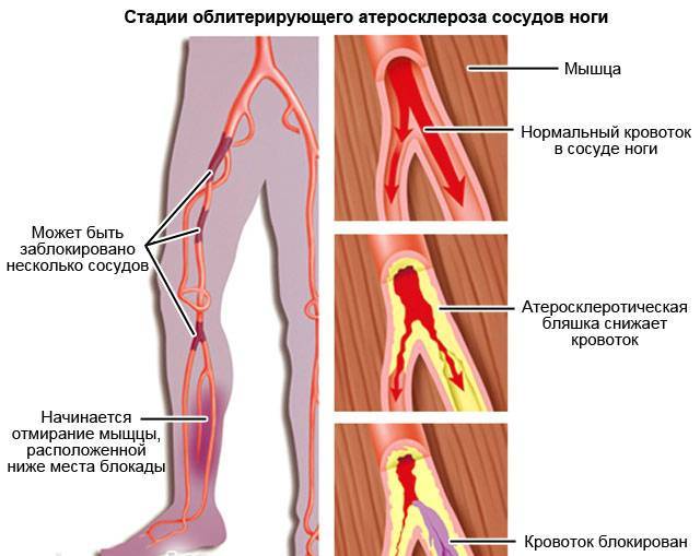Облитерирующий атеросклероз сосудов нижних конечностей