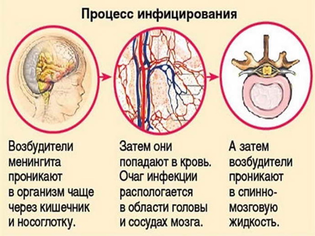 Вирусный менингит: инкубационный период, первые признаки и варианты лечения