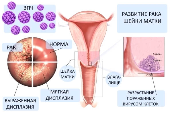 Вирус папилломы человека у женщин, что это такое? Причины и лечение