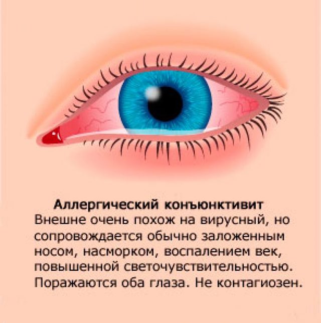 Аллергический конъюнктивит у взрослых: симптомы и лечение