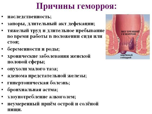 Наружный геморрой: симптомы, фото и способы лечения