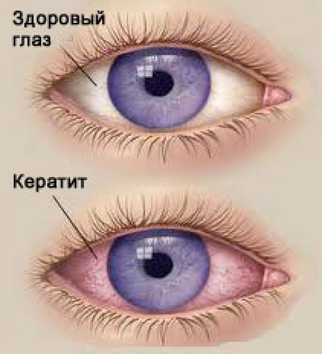 Симптомы кератита, профилактика и схема лечения