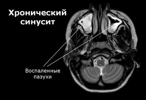 Синусит у взрослых: симптомы и схема лечения на дому