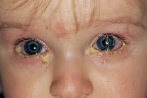 Аденовирусный конъюнктивит: фото, симптомы и лечение