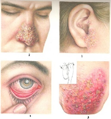 Аспергиллез: симптомы у человека, диагностика и лечение