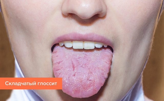 Глоссит что это такое, симптомы и лечение