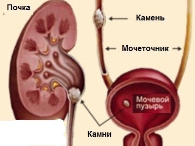Как лечить камни в мочевом пузыре