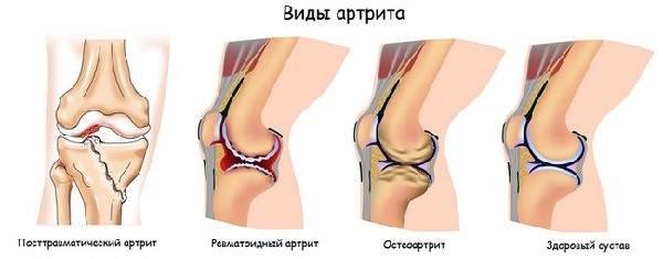 Первые симптомы артрита коленного сустава, лечение и правила профилактики