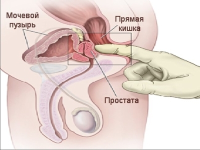 Можно ли вылечить хронический простатит в домашних условиях?