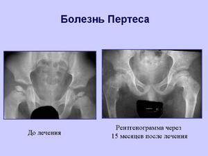 Причины, симптомы и лечение болезни Пертеса у детей и взрослых