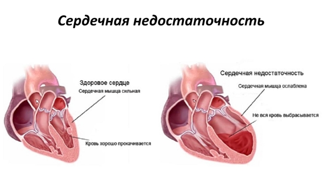 Как лечить сердечную недостаточность? Таблетки и народные средства