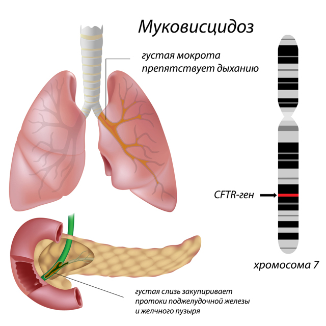 Симптомы муковисцидоза, причины и лечение