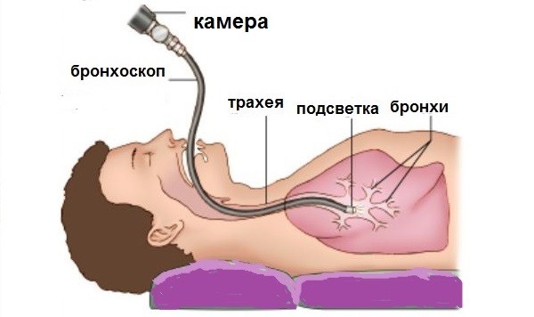 Аспергиллез: симптомы у человека, диагностика и лечение