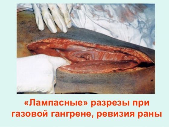 Газовая гангрена: возбудитель болезни, симптомы и варианты лечения