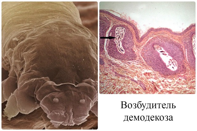 Демодекоз у человека, симптомы и лечение демодекоза на лице