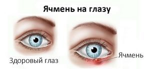 Быстрое лечение ячменя на глазу за 1 день в домашних условиях