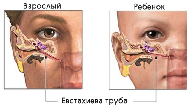 Евстахиит: что это такое? Симптомы и способы лечения