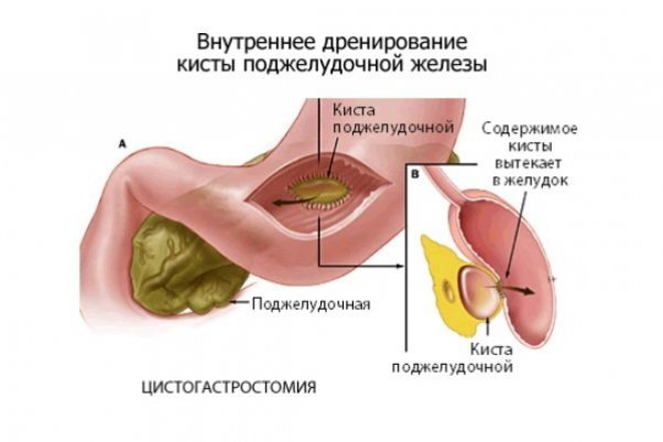 Киста поджелудочной железы: симптомы, причины и лечение