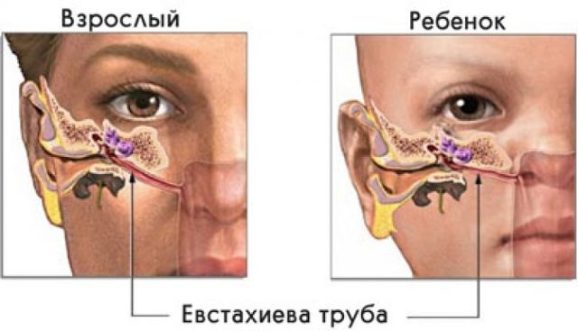 Евстахиит: что это такое? Симптомы и способы лечения