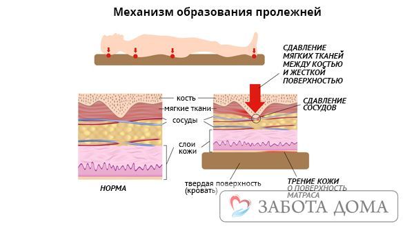 Пролежни у лежачих больных: лечение и профилактика, фото в начальной стадии