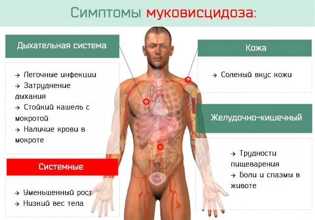 Симптомы муковисцидоза, причины и лечение