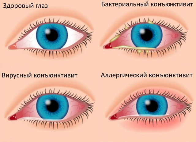 Симптомы конъюнктивита у взрослых, лечение и меры профилактики