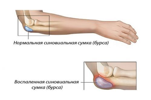 Бурсит локтевого сустава: фото, симптомы и лечение