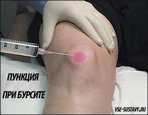 Как эффективно лечить бурсит коленного сустава и что это такое?