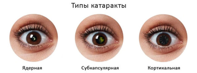 Симптомы катаракты, лечение и способы профилактики