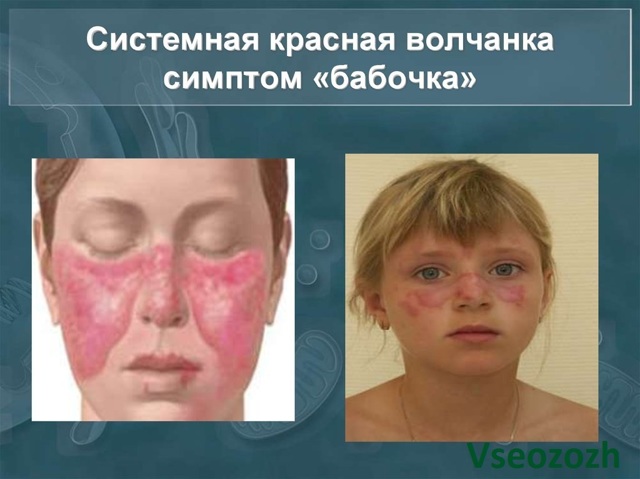 Красная волчанка, что это за болезнь? Фото, лечение и продолжительность жизни