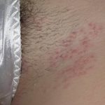 Как лечить герпес в интимной зоне у женщин, симптомы и фото высыпаний