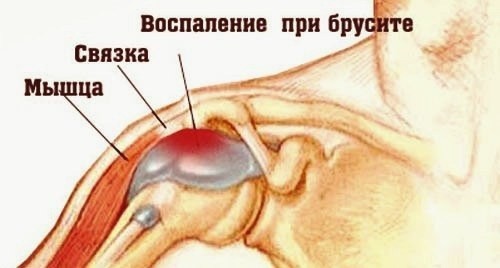 Как выглядит бурсит плечевого сустава, его первые симптомы и варианты лечения