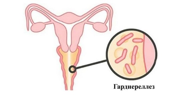 Симптомы гарднереллеза у женщин, основные препараты для лечения