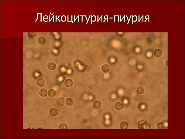 Лейкоциты в моче у женщин: норма